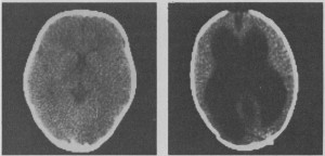 hydrocephalus 1980-lewin- hydrocephalus 1980 lewin 300x144 The Changing Brain